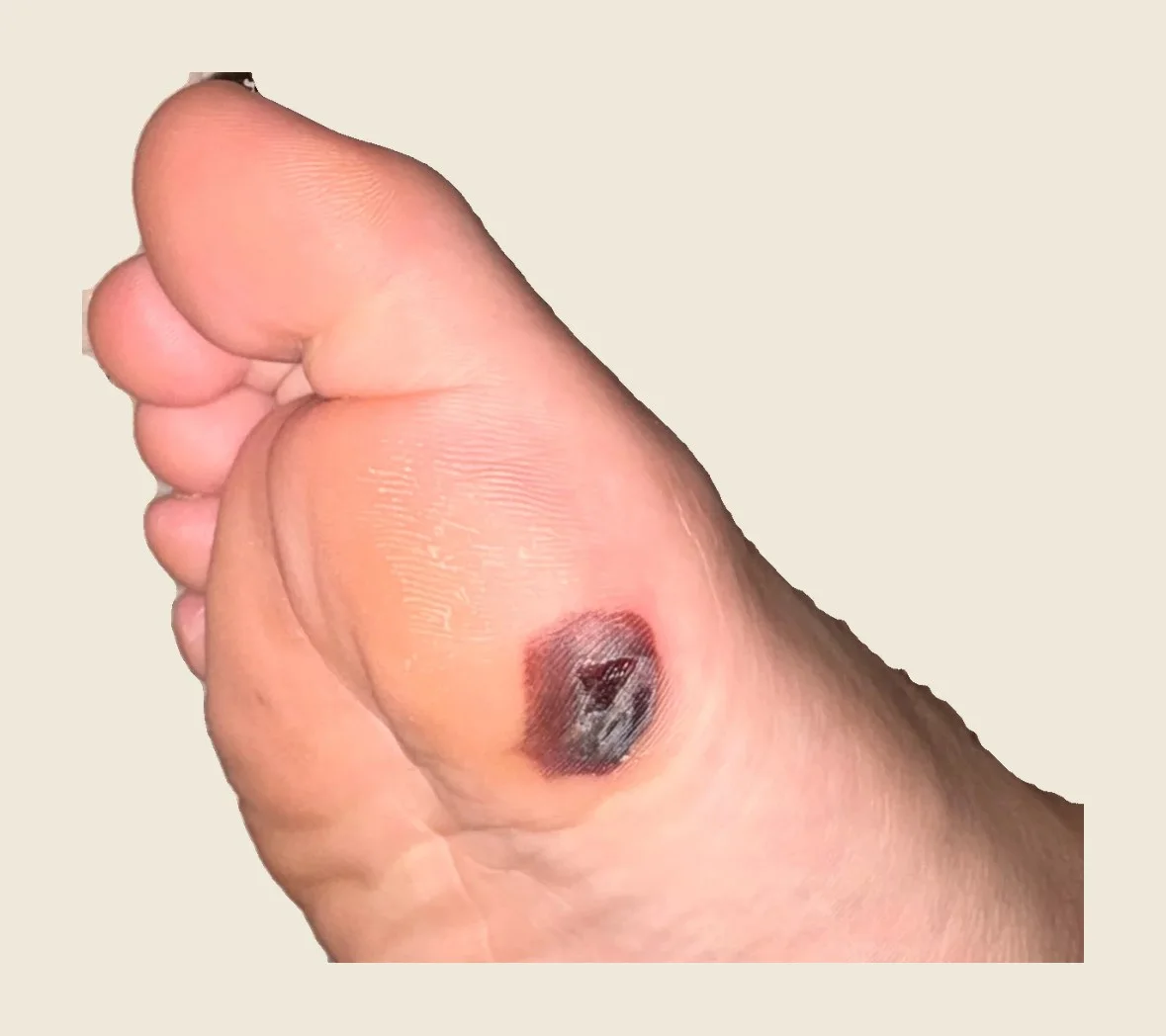 Imagen clínica: hematoma bajo hiperqueratosis en la planta, antes del deslaminado