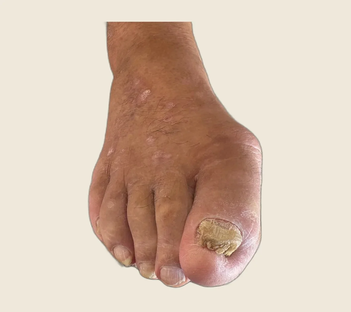 Imagen clínica: uña engrosada por onicomicosis, antes del fresado