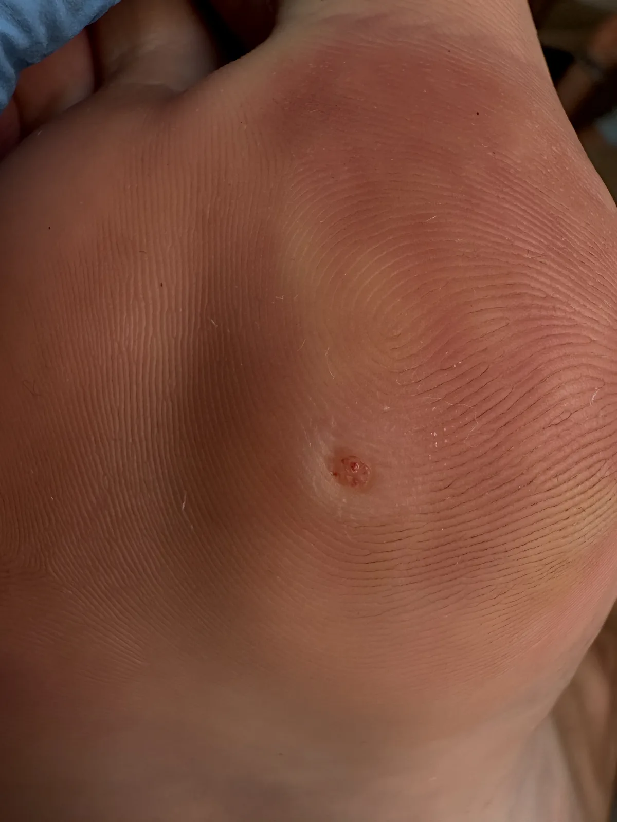 Imagen clínica: macrofotografía de papiloma plantar en zona de apoyo